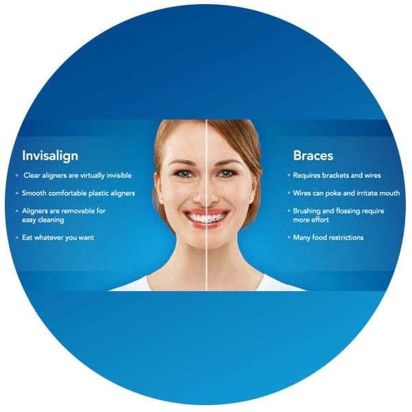 is smile direct club as good as invisalign
