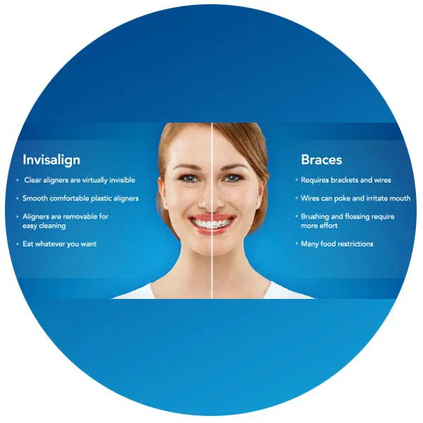 Invisalign Smile Direct Club